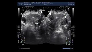Ultrasound Video showing two uterine masses and ovarian cyst.