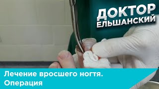 Лечение вросшего ногтя операция