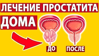 КАК ВЫЛЕЧИТЬ ПРОСТАТИТ? 3 способа от врача!
