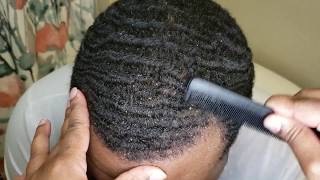 What a difference a couple of days make!(mini dandruff compliation)