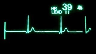 ეკგ მონიტორი 2 / სინუსური ბრადიკარდია (გაიშვიათებული გულისცემა) / sinusuri bradikadia
