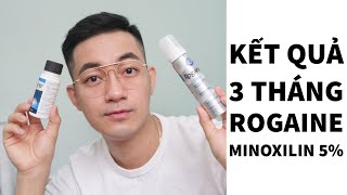 TTL - UPDATE 3 THÁNG DÙNG ROGAINE, ƯU NHƯỢC ĐIỂM CỦA DẠNG NƯỚC VÀ DẠNG BỌT