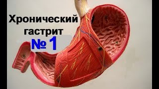 Хронический гастрит. Язвенная болезнь желудка - как лечить желудок № 1| #рецептыздоровья