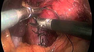 Surgery for GERD, Hiatal Hernia Repair, Nissen Fundoplication, Laparoscopic Surgery, "Advanced Su