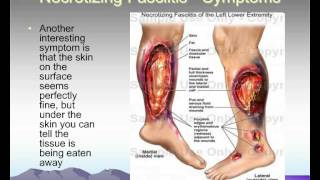 Necrotizing Fasciitis