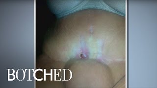 "Botched" Doctors Tackle an Alien Stomach! | E!
