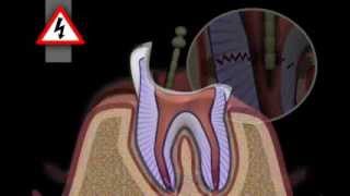 Tooth Core Build Up