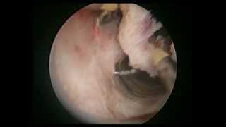 Art of hysteroscopy endometrial resection ablation by osama shawki
