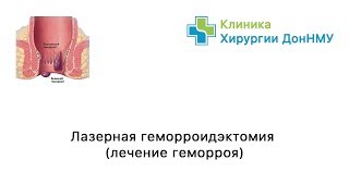 Лазерная геморроидэктомия, уделение хронического абсцесса