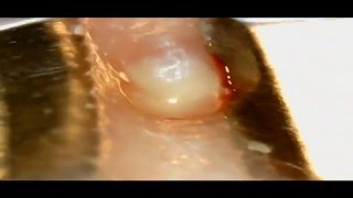 Pimple removal (прыщ удаление под микроскопом)