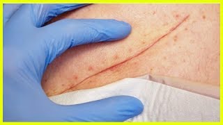 Techniques de base pour bien soigner une plaie