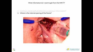 MR Imaging of Perianal Fistulas a step-by-step guide for trainees (ESCP Trainee Video)