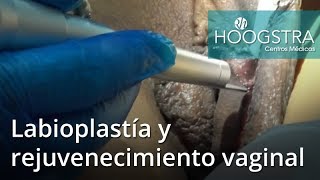Labioplastía y rejuvenecimiento vaginal (19025)