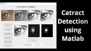 Catract Detection using Matlab