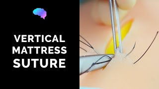Vertical Mattress Suture - OSCE Guide