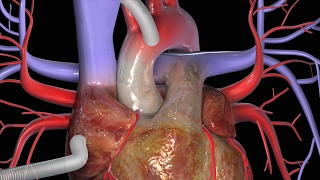 冠動脈バイパス術（CABG）