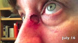 Mohs Surgery of Basal Cell Carcinoma Recovery