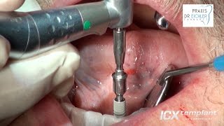 Vier ICX-templant® Implantate im Unterkiefer mit 4-on-ICX und ICX-MAGELLAN/ ICX-SafetyGuide System.