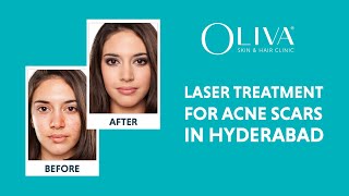 Laser Treatments For Acne Scars In Hyderabad – Dermatologists For Pimple Marks