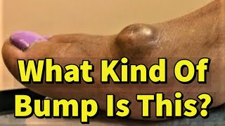 What Kind Of Bump Is This?: A Big Growth On Top Of The Foot