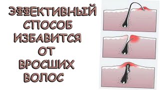Вросшие волосы / Советы по их минимизации