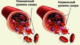 Как нормализовать сахар в крови! Уровень сахара норма сильнейший народный рецепт