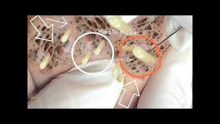 Новое выдавливание ПРЫЩЕЙ и ЧЕРНЫХ ТОЧЕК!  p4