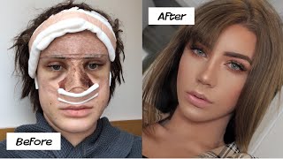 My plastic surgery in Korea experience! (part 2)