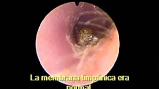 Alive Tick in the Ear -Garrapata viva  en el Oído