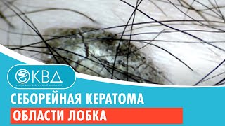 Себорейная кератома области лобка. Клинический случай №7