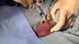 SPERM EXTRACTION: Two percutaneous techniques