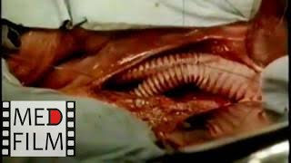 Атеросклероз нижних конечностей © Surgery atherosclerosis of lower limb arteries