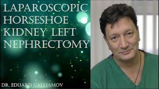 Horseshoe kidney right nephrectomy 2016 / Нефрэктомия левой половины подковообразной почки