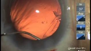 Removal of Subincisional cortex