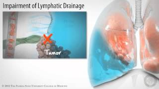 Pleural Space: Part 3 of 3- Pleural Effusions [HD]