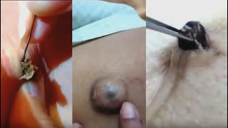 ВЫДАВЛИВАЕМ ОГРОМНЫЕ ЧЕРНЫЕ ТОЧКИ