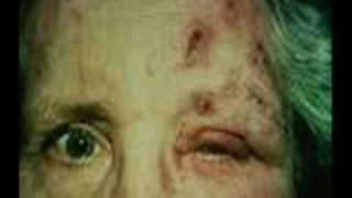 Como Curar El Herpes