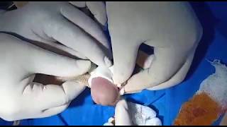 RYPS Circumcision Stapler- Non-Flip Circumcision Surgery with Topical Anesthesia