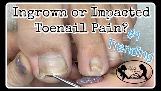 ? Impacted or Ingrown Toenail Pedicure Tutorial ?