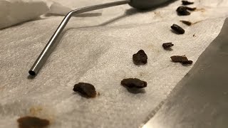 521 - Stubborn Impacted Ear Wax Removal from Both Ears