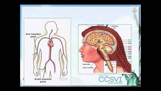 Ivo Petrov, MD [Combined CCSVI & Stem Cell Treatments | CCSVI Symposium 2011 - 39 of 46]