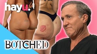 Beware The Booty! Butt Job Before & After Compilation | Botched