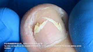 甲溝炎-paronychia 베트남/realxing video 226/涷甲/嵌甲/Ingrown nail treatment（how to fix ingrown toenail）