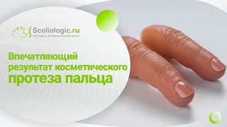 Косметический протез пальца.