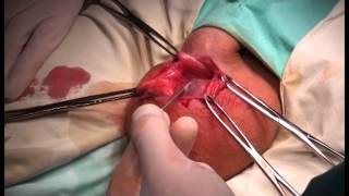 Hydrocele surgery   Операция Бергмана при гидроцеле