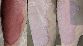 Dead Sea:  Days 6 through 10 progression on psoriasis [Psoriasis]