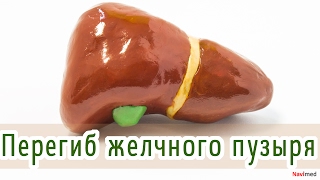 Что такое перегиб загиб желчного пузыря