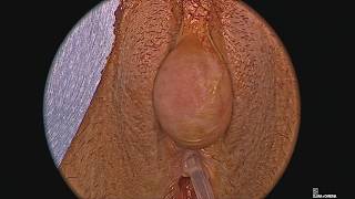 Clitoral Cyst of "Epidermal" Proportions
