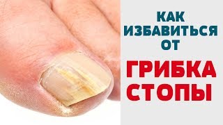 КАК ЛЕЧИТЬ ГРИБОК КОЖИ (СТОПЫ) Избавиться от грибка ногтей Запущенный грибок стопы