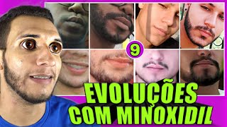 RESULTADOS E EVOLUÇÕES COM MINOXIDIL #9 ???